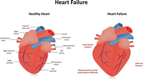 global hypokinesia of lv|global hypokinesis life expectancy.